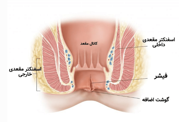 شقاق مقعد