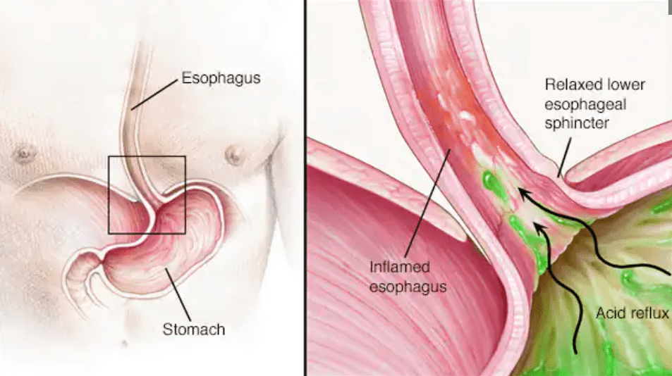 بیماری رفلاکس معده به مری